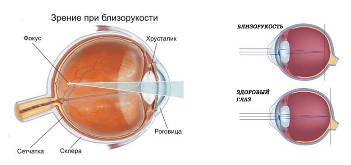 Близорукость возраст