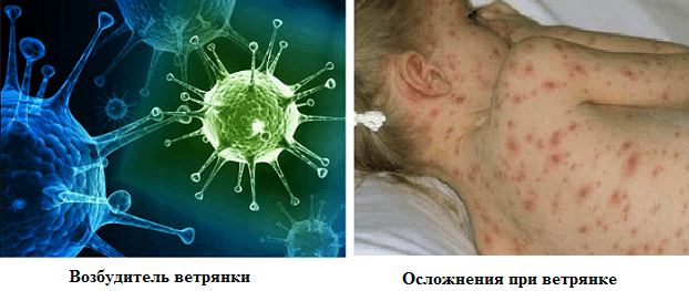 Появление осложнений при заболевании у детей