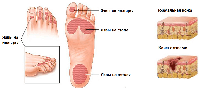 Появление язв